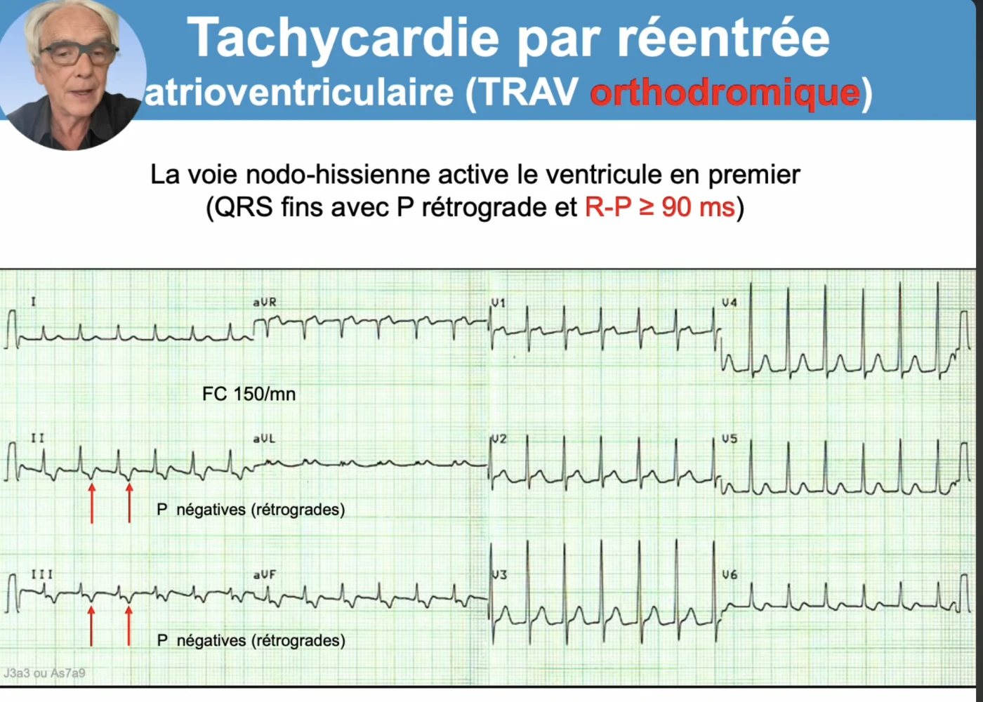 Tachycardie par réentrée atrioventriculaire orthodromique sur douze dérivations, fréquence 150 par minute : la voie nodo-hissienne active le ventricule en premier, d'où des QRS fins, avec ondes P rétrogrades négatives en DII et DIII signalées par des flèches rouges et intervalle R-P supérieur ou égal à 90 ms