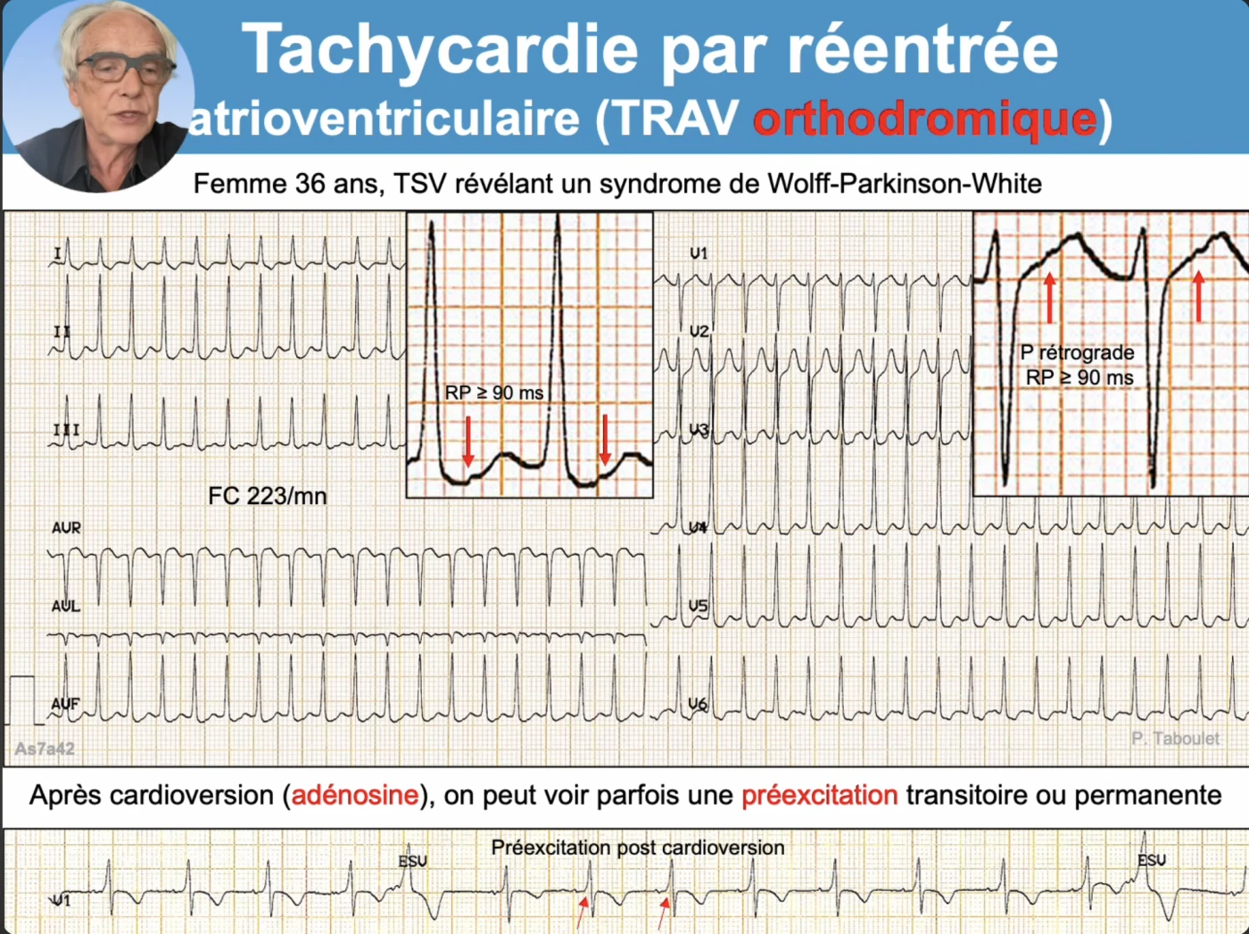 Tachycardie par réentrée atrioventriculaire orthodromique révélant un syndrome de Wolff-Parkinson-White chez une femme de 36 ans : tachycardie régulière à QRS fins à 223 par minute, onde P rétrograde nette après le QRS avec intervalle RP supérieur ou égal à 90 ms (agrandissements en dérivation inférieure et en V1, flèches rouges), et après cardioversion par adénosine apparition d'une préexcitation transitoire ou permanente