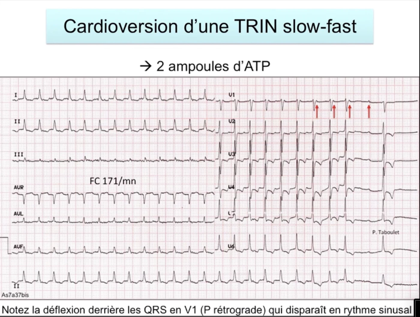 Cardioversion d'une TRIN par adénosine — la P rétrograde derrière le QRS en V1 disparaît en rythme sinusal