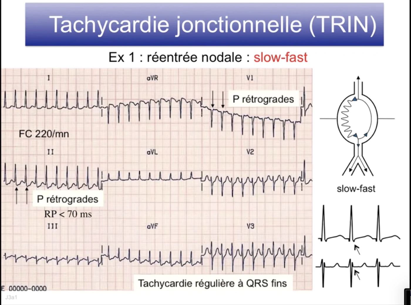 TRIN slow-fast — P rétrogrades, RP inférieur à 70 ms, FC 220/min, QRS fins