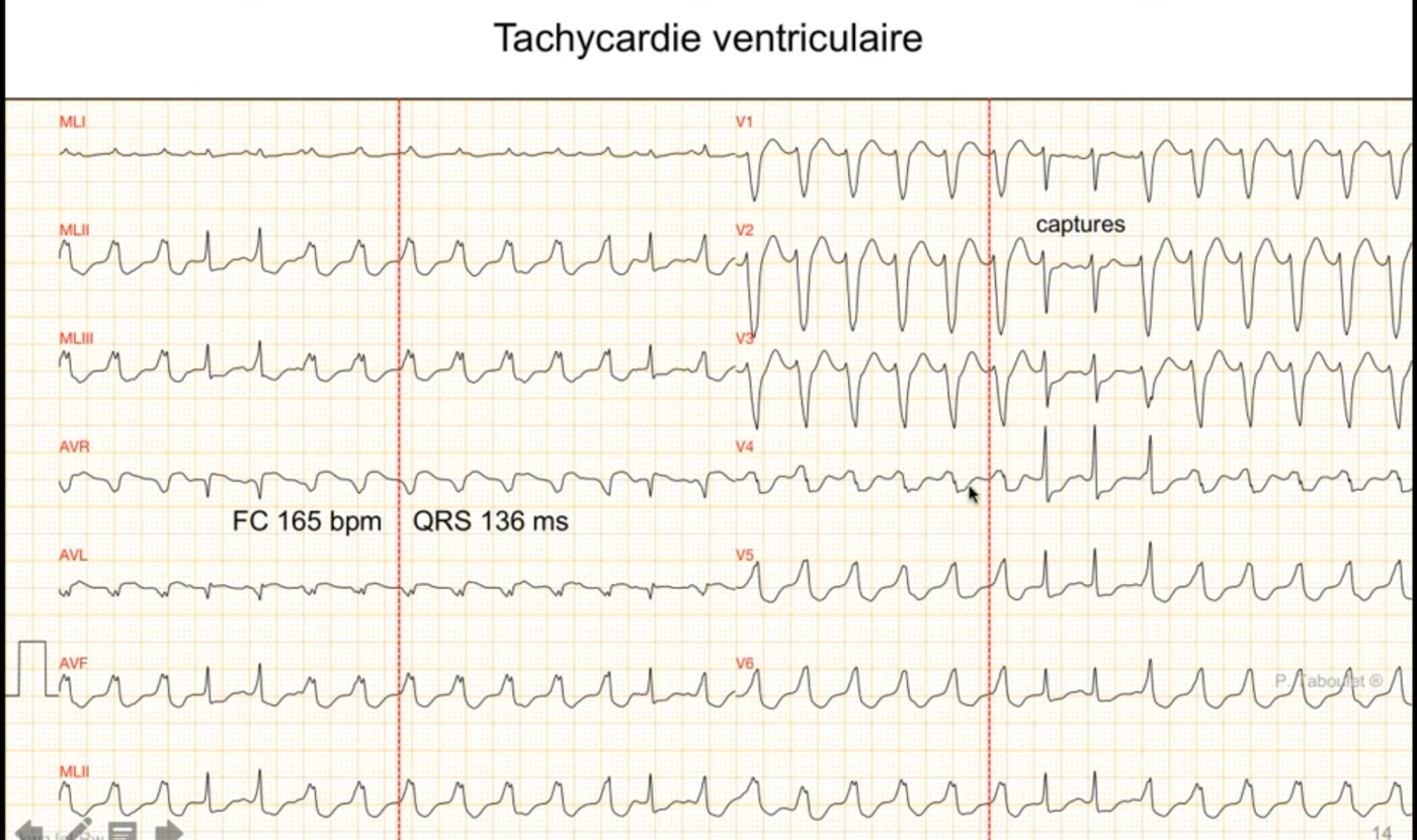 Tachycardie ventriculaire à 165 par minute, QRS 136 ms, sur douze dérivations ; lecture en DI avec retard d'inscription de l'onde R, front de dépolarisation très ralenti en DII avec aspect QS, onde Q très large en aVR par activation remontant depuis l'apex ; sur la droite du tracé apparaissent des QRS fins de capture prouvant la dissociation atrioventriculaire et donc la nature ventriculaire de la tachycardie
