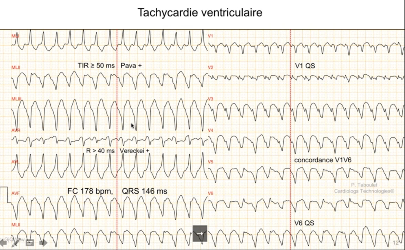 Tachycardie ventriculaire à 178 par minute, QRS 146 ms, sur douze dérivations ; concordance de V1 à V6 avec aspect QS en V1 et en V6 traduisant l'absence de conduction vers le ventricule gauche, temps d'inscription de l'onde R supérieur à 50 ms signe de Pava positif, onde R de plus de 40 ms avec critère de Vereckei positif en aVR, crochetage des complexes