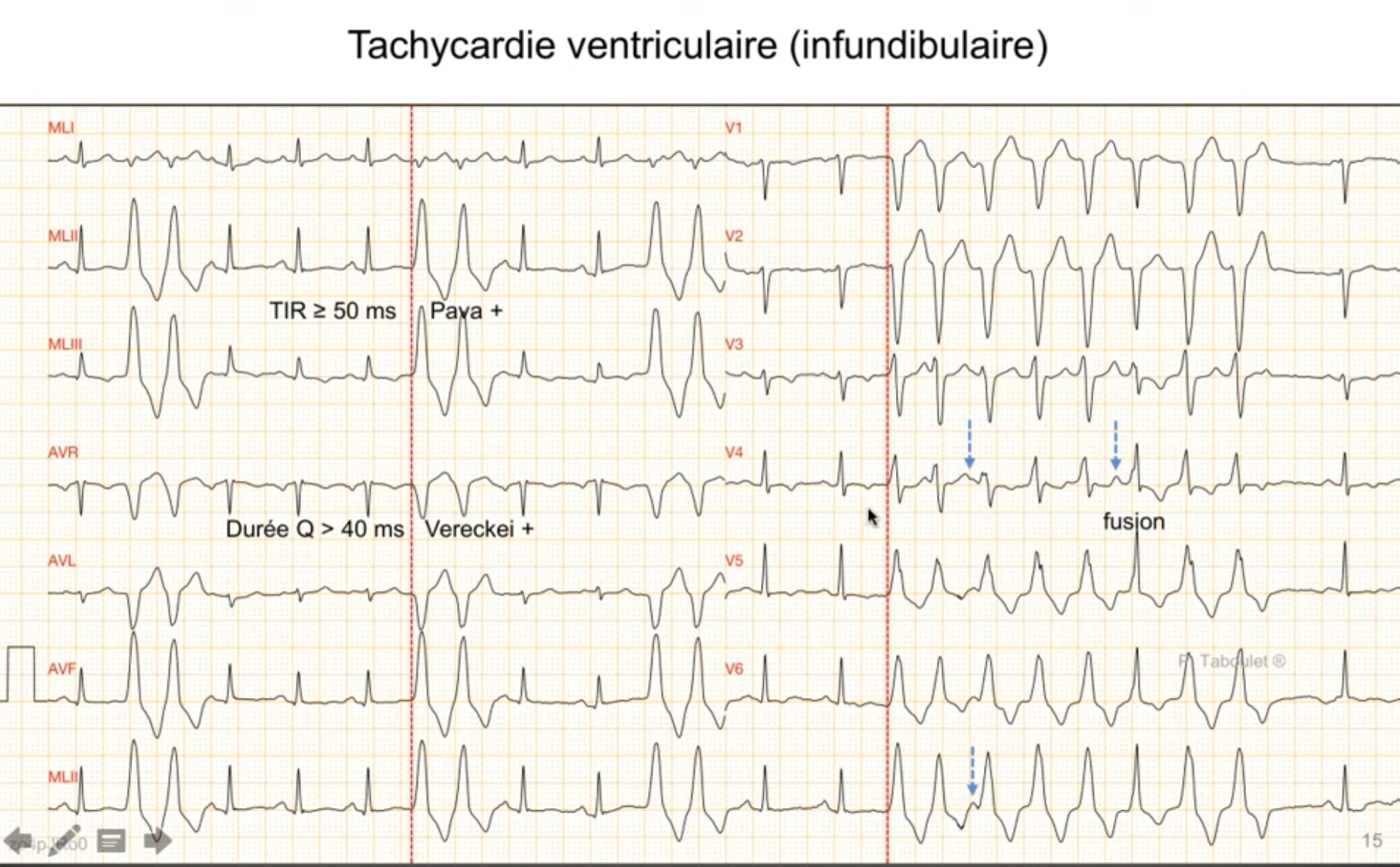 Tachycardie ventriculaire infundibulaire sur douze dérivations ; morphologie de retard gauche avec QRS négatif en V1 traduisant une origine dans le ventricule droit et axe droit inférieur avec grandes ondes R en DII DIII et aVF correspondant à la chambre de chasse ; temps d'inscription de l'onde R supérieur à 50 ms signe de Pava positif, durée de l'onde Q supérieure à 40 ms critère de Vereckei positif, nombreux complexes de fusion signalés par des flèches et dissociation atrioventriculaire