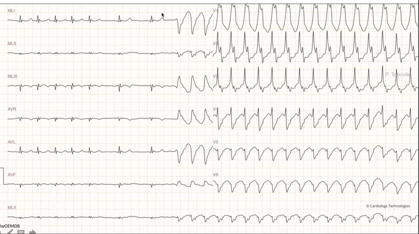 Salve de tachycardie ventriculaire — début brutal d'une tachycardie à QRS larges, changement complet d'axe d'amplitude et de largeur par rapport au rythme sinusal