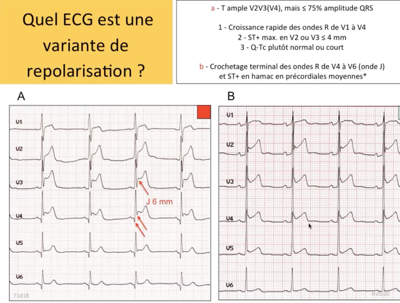 Quel ECG est une variante de repolarisation ? A=STEMI (J 6mm), B=variante précoce (hamac, crochetage R)