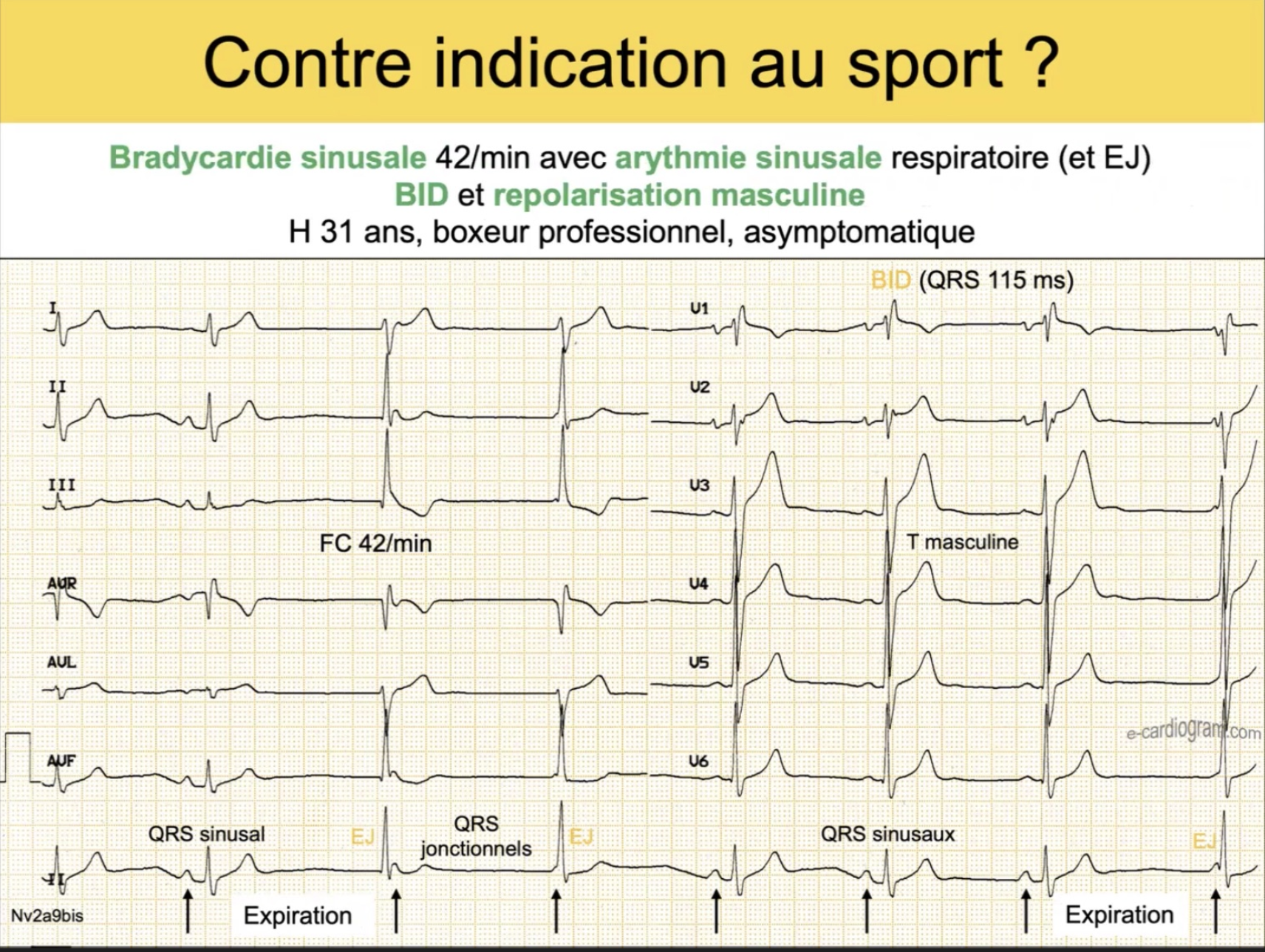 Variantes normales du sportif — bradycardie 42/min, arythmie sinusale, BID, échappements jonctionnels, T masculines