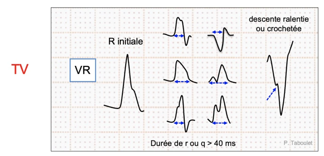 Signe de Vereckei en aVR : R initiale positive, r ou q > 40 ms, descente ralentie ou crochetée