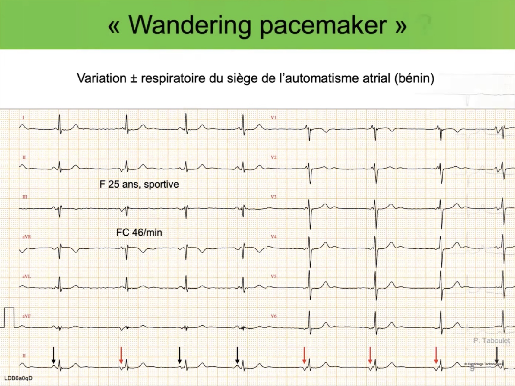 Wandering pacemaker — variation morphologie onde P, sportive 25 ans, FC 46/min