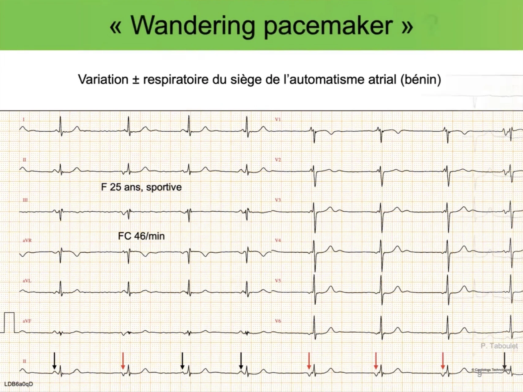 Wandering pacemaker — variation morphologie onde P, sportive 25 ans, FC 46/min