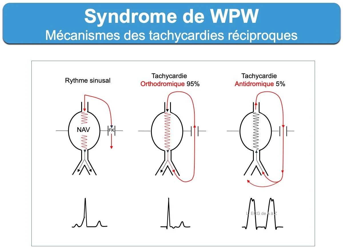 Syndrome de WPW, mécanismes des tachycardies réciproques : en rythme sinusal l'influx descend en parallèle par le nœud et par le faisceau de Kent, créant une onde delta par fusion ; en tachycardie orthodromique l'influx descend par le nœud et remonte par le Kent, donnant un QRS fin sans onde delta ; en tachycardie antidromique l'influx descend par le Kent seul et remonte par le nœud, donnant un QRS large entièrement préexcité (préexcitation maximale, sans fusion)