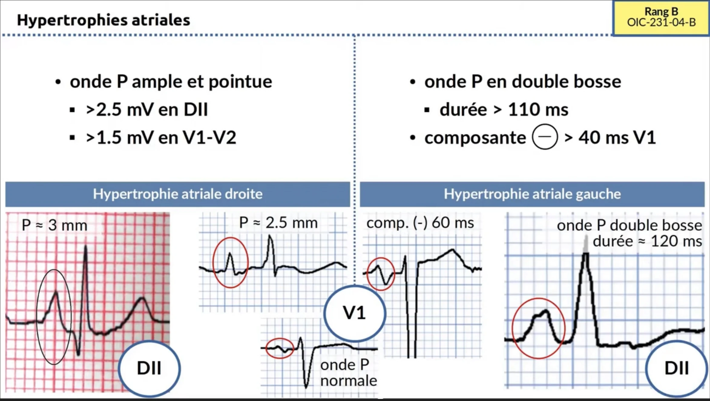 Hypertrophies atriales — tracés ECG HAD et HAG comparatifs