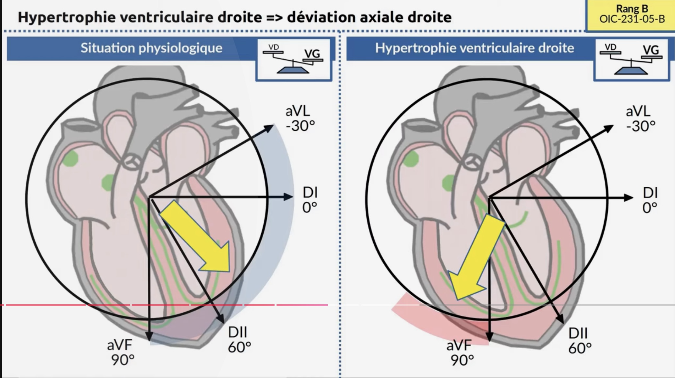 HVD — déviation axiale droite