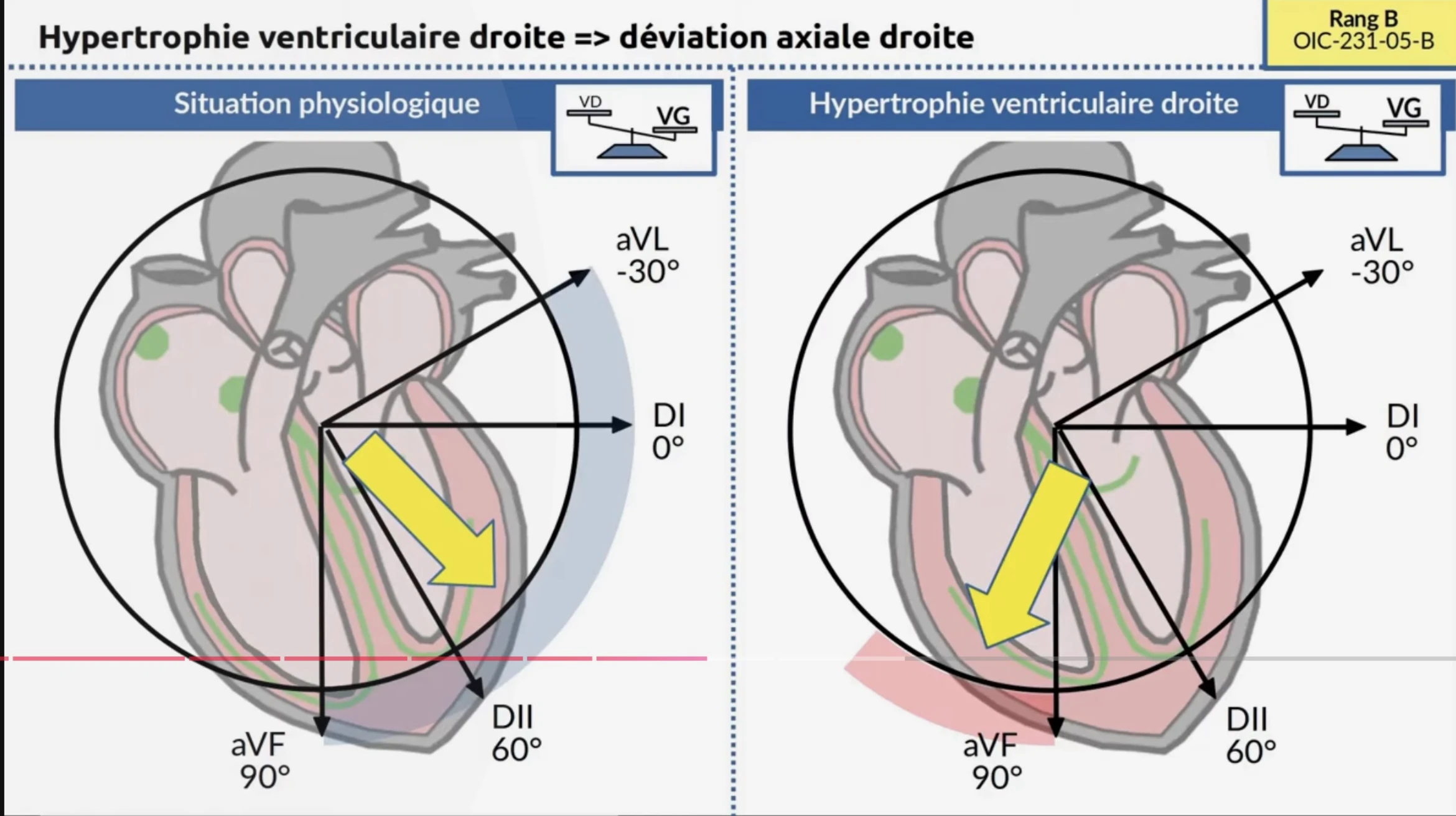 HVD — déviation axiale droite
