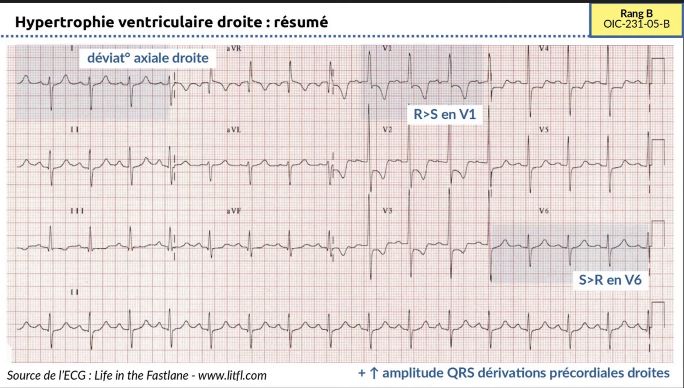 HVD résumé ECG 12 dérivations