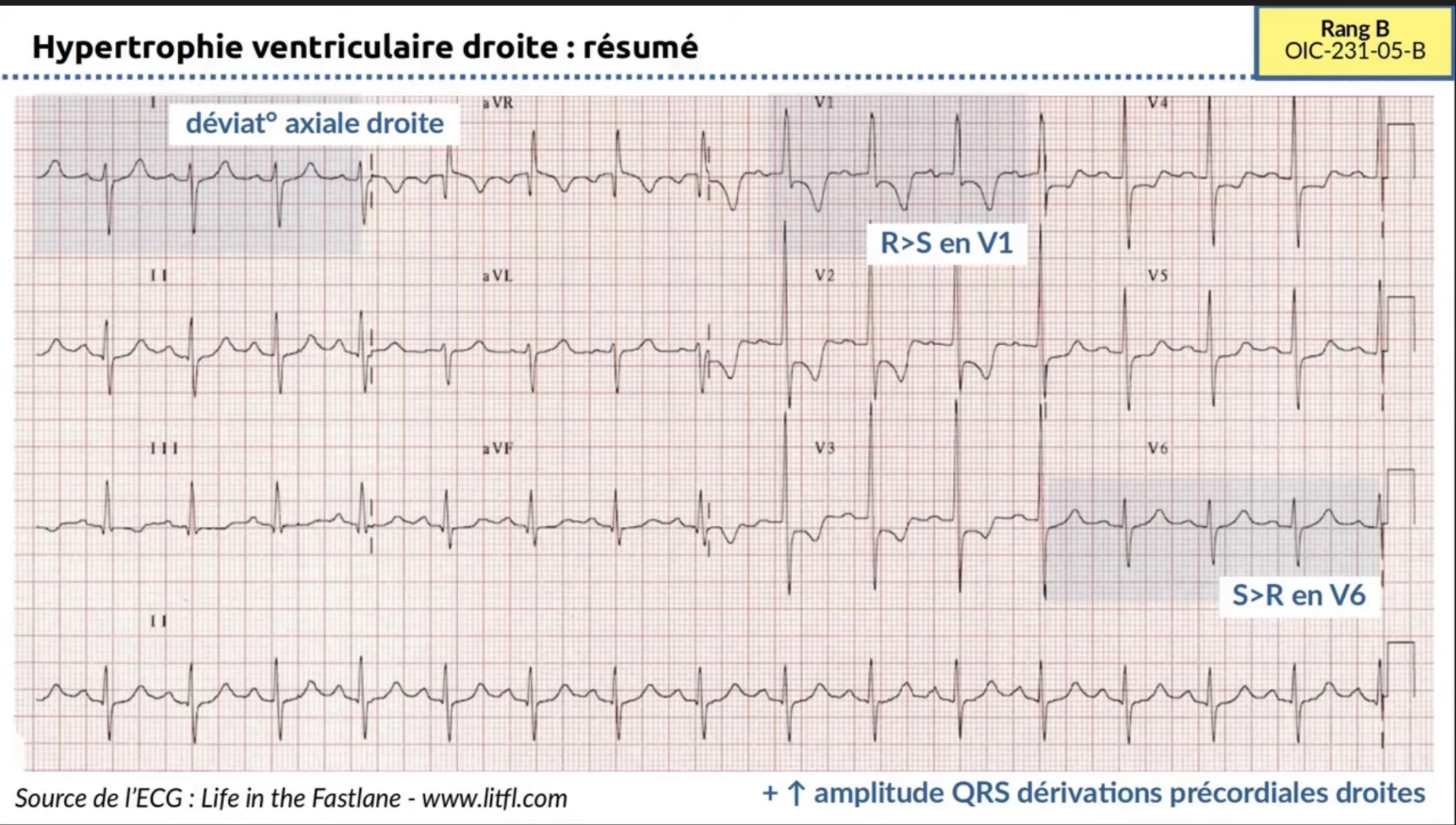 HVD résumé ECG 12 dérivations