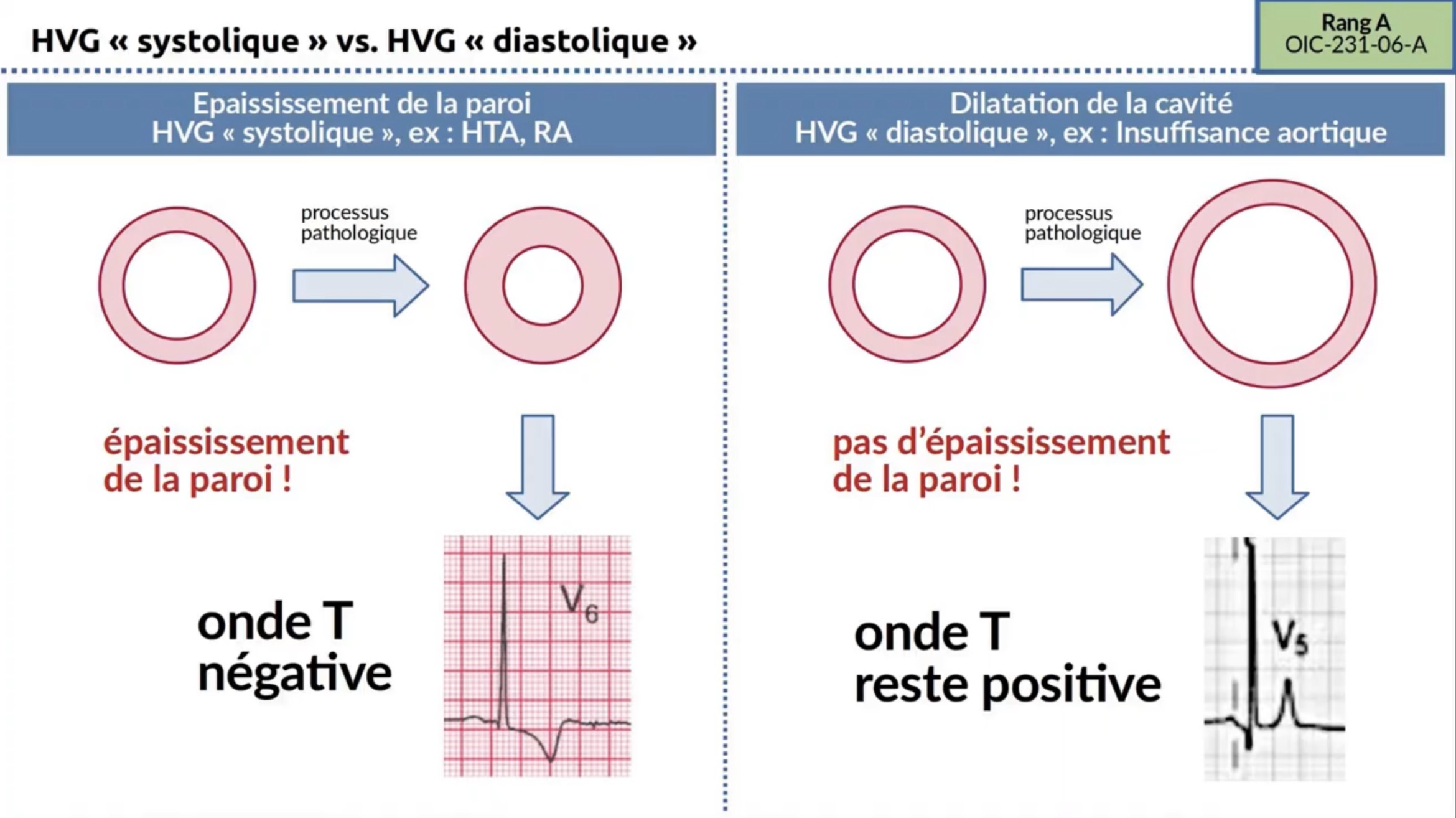 HVG systolique vs diastolique — onde T négative ou positive