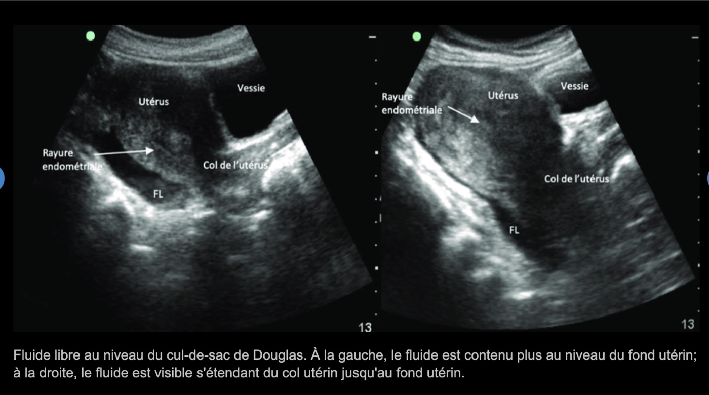 Fluide libre anéchogène dans le cul-de-sac de Douglas — voie sus-pubienne