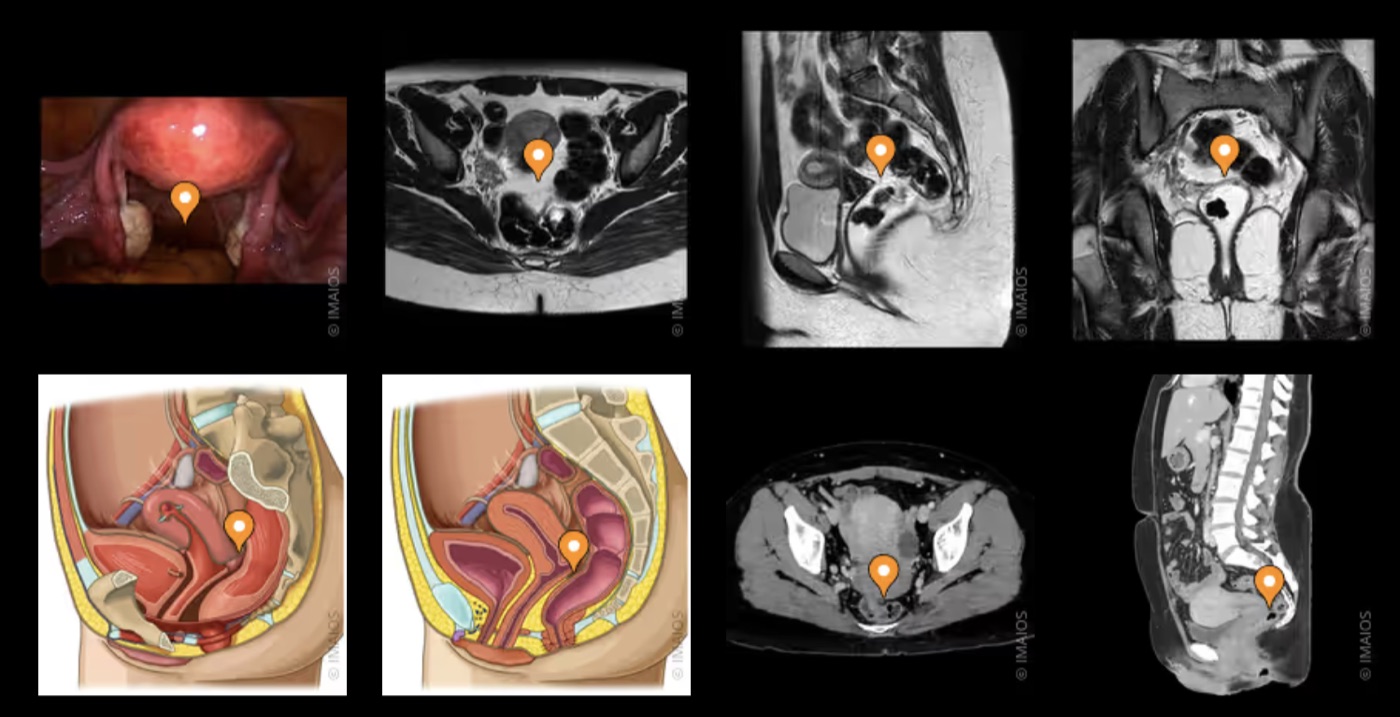 Cul-de-sac de Douglas (recto-utérin) — anatomie et imagerie