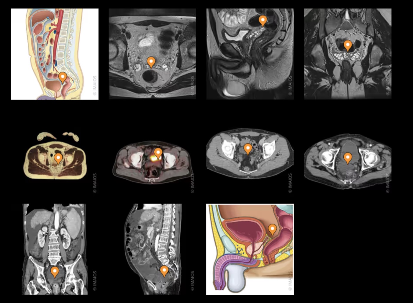 Cul-de-sac recto-vésical chez l'homme — anatomie et imagerie