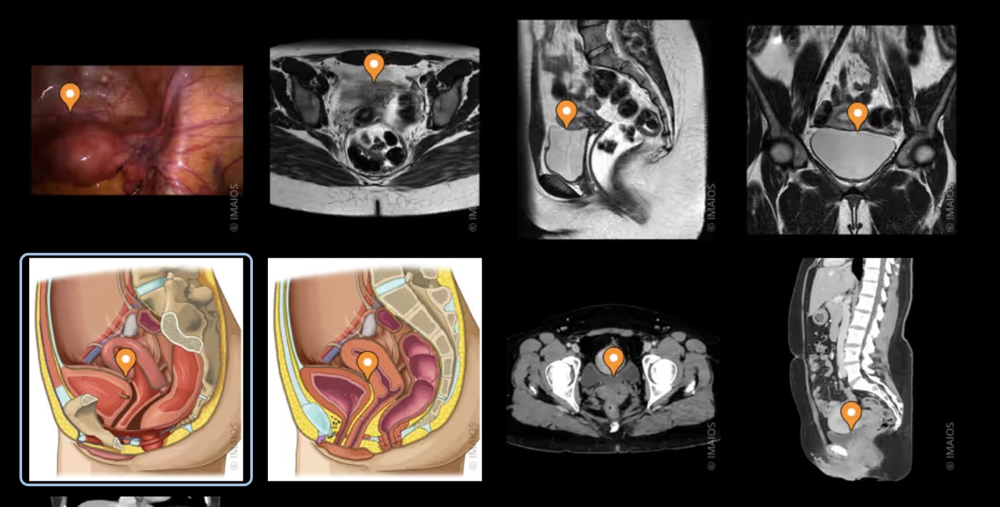 Cul-de-sac vésico-utérin — anatomie et imagerie