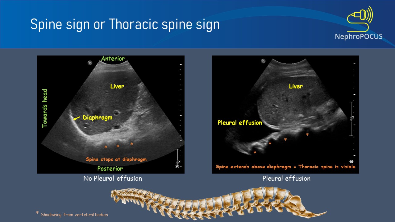 Spine sign — comparaison normal vs épanchement pleural