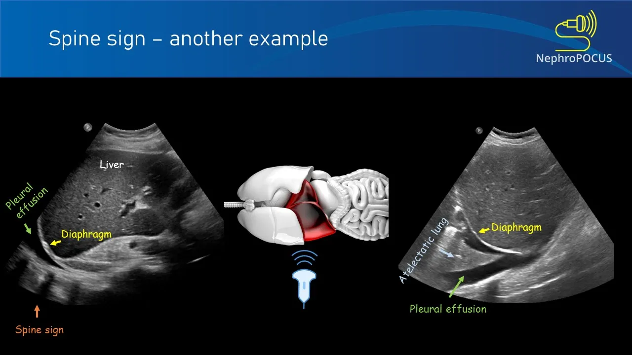 Spine sign — autre exemple avec épanchement pleural