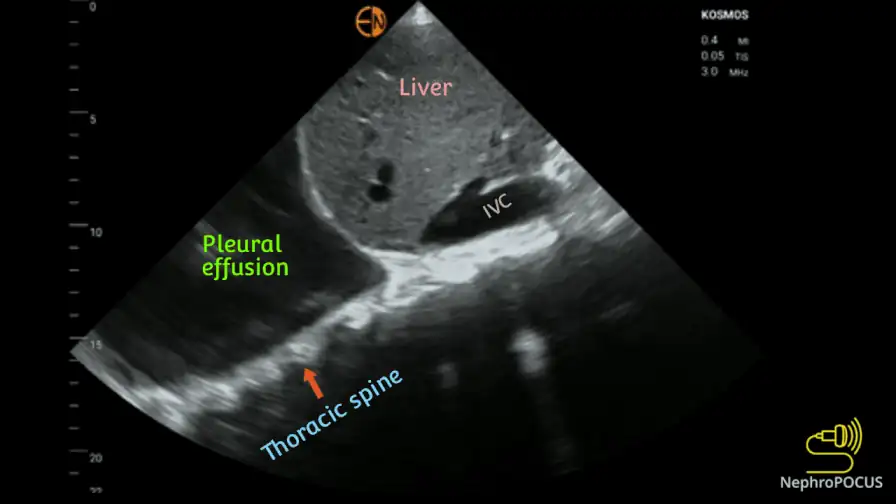 Boucle ciné — spine sign et épanchement pleural