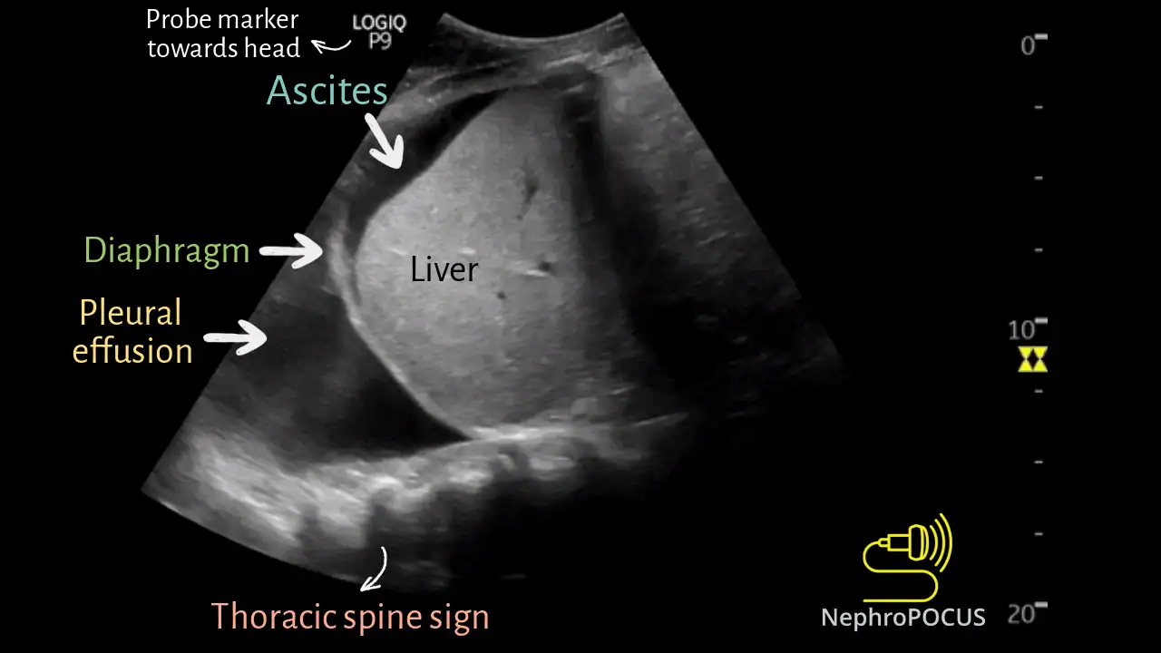 Boucle ciné — ascite, épanchement pleural et spine sign